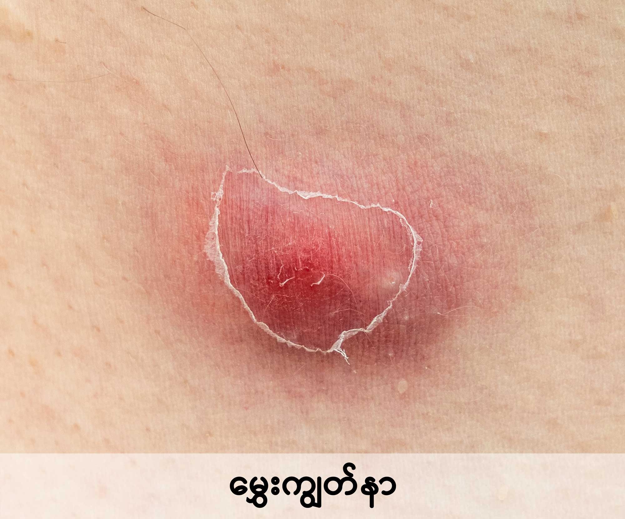 Common skin infections in children image1