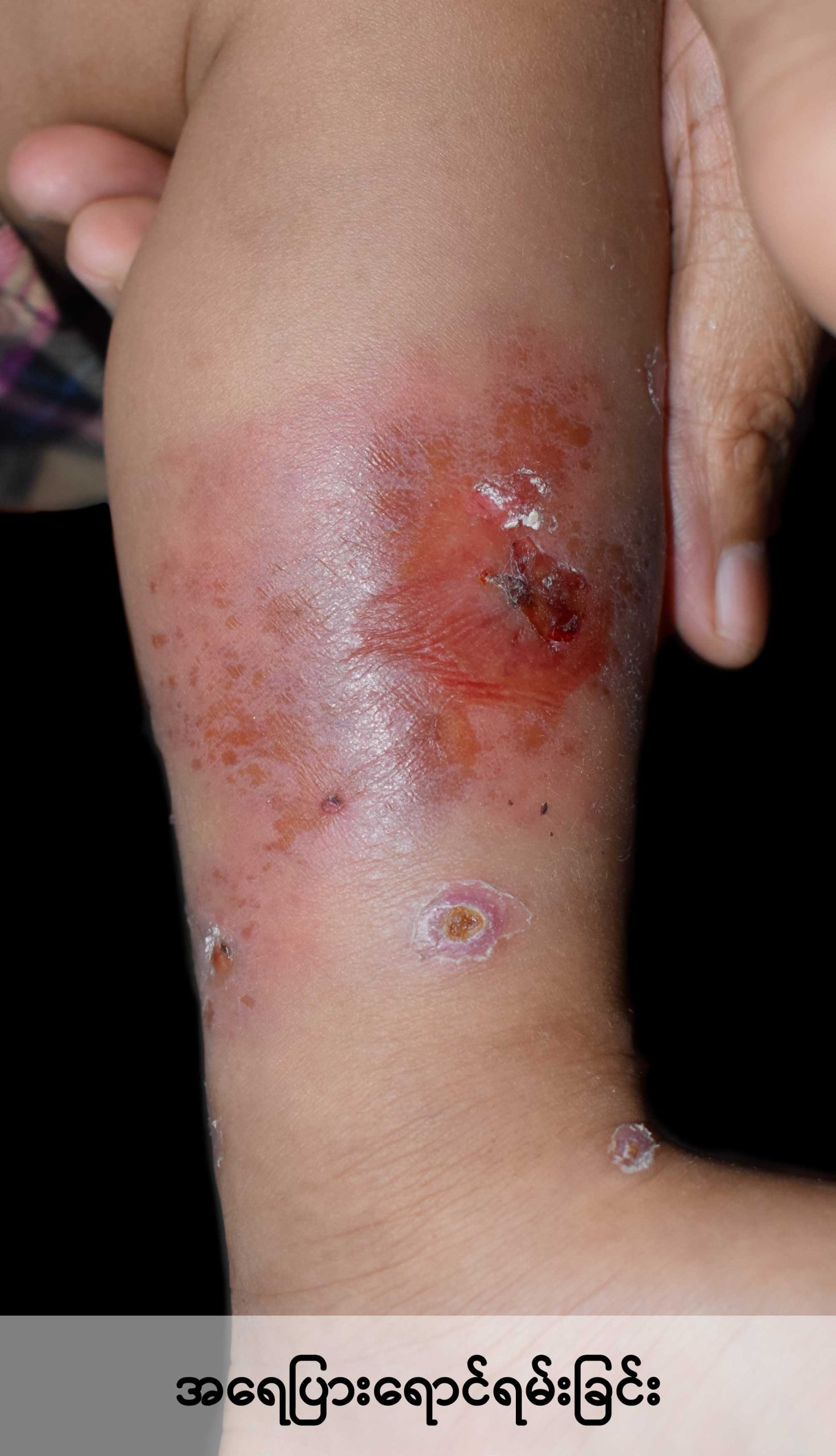 Common skin infections in children image3