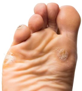 Corns and calluses image