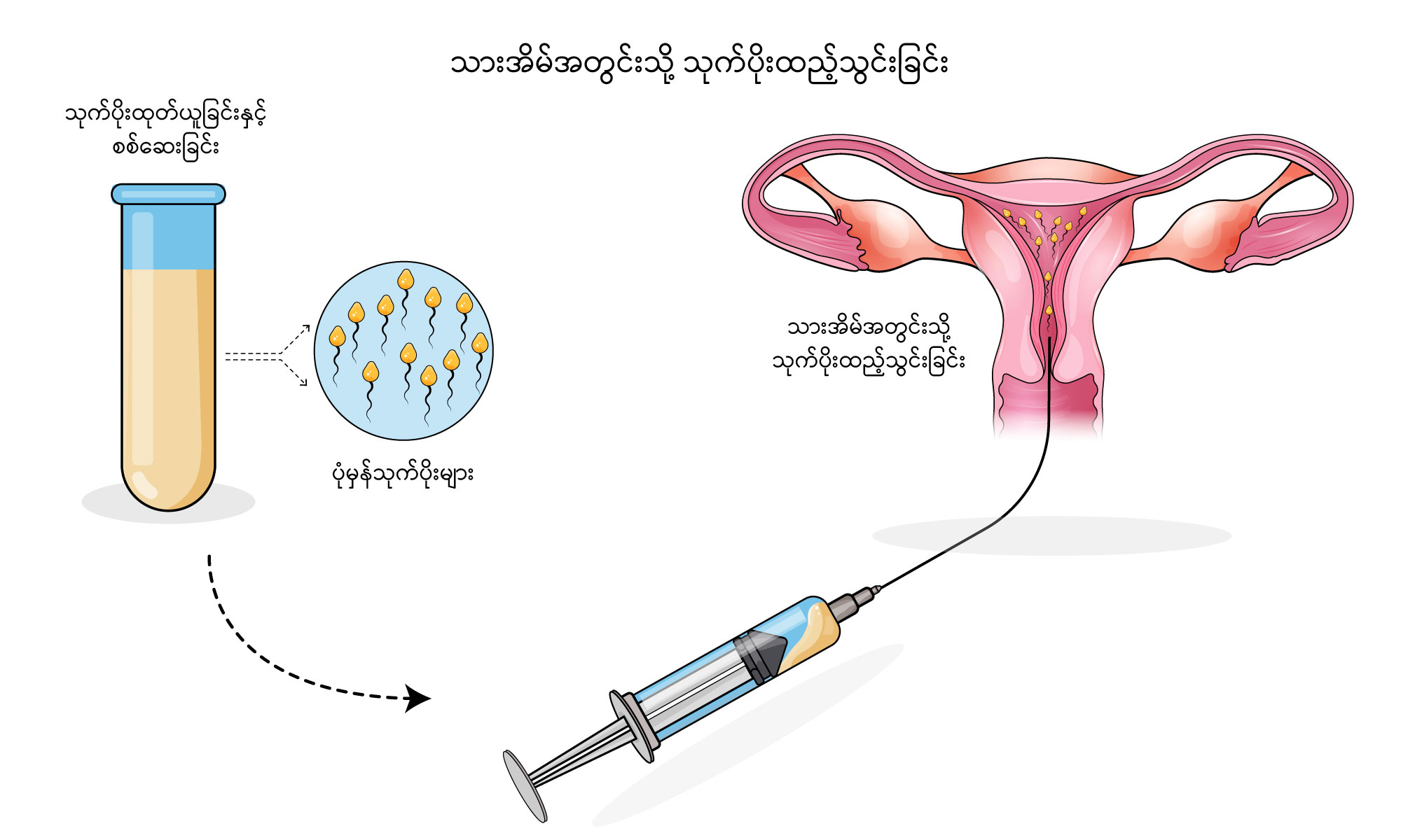 Front Inseem Intrauterine insemination (သားအိမ်တွင်းသို့ သုက်ပိုးထည့်သွင်းခြင်း ...