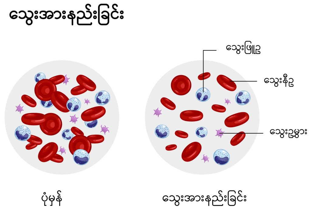 Iron deficiency anaemia image