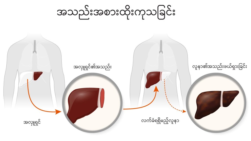 Liver transplant image