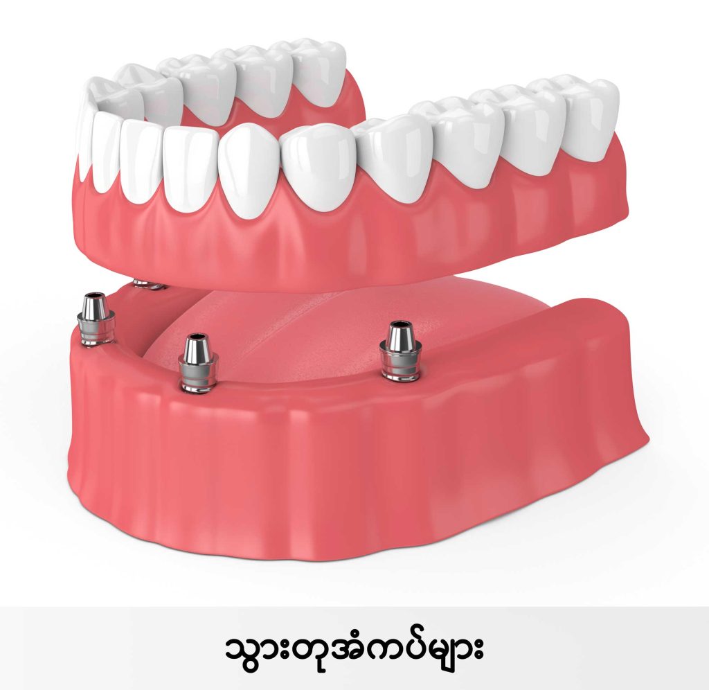 Dentures IMG3