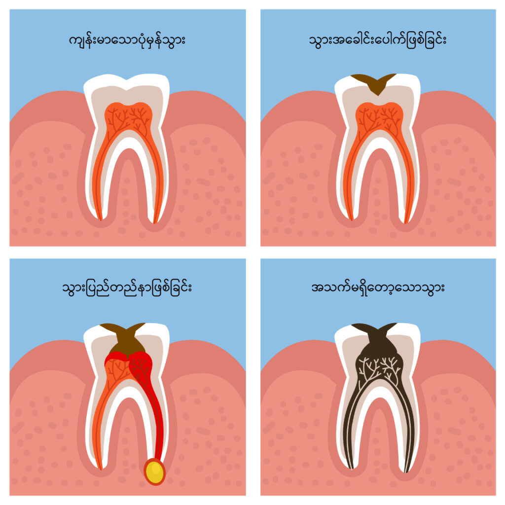 Dental caries image 2