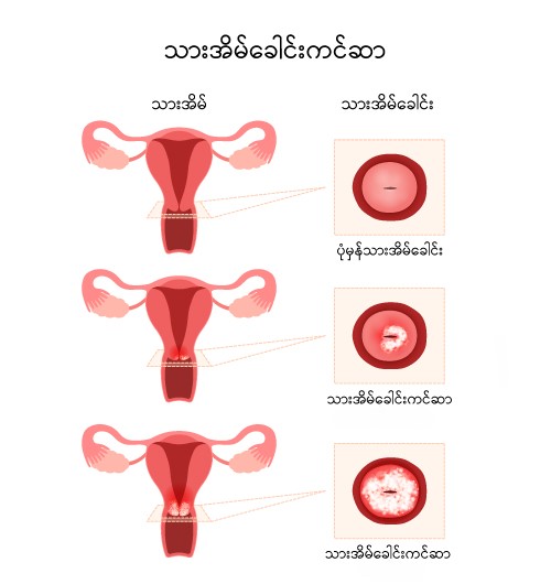 Cervical cancer image