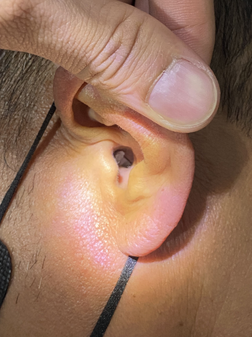 Foreign bodies in ear and nose image1