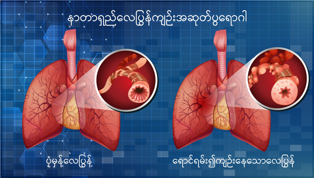 COPD image 1
