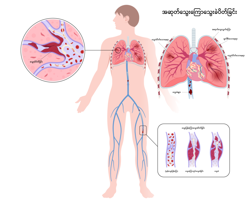 Pulmonary Embolism image