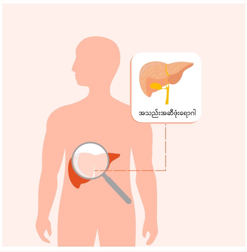 Fatty liver disease image1