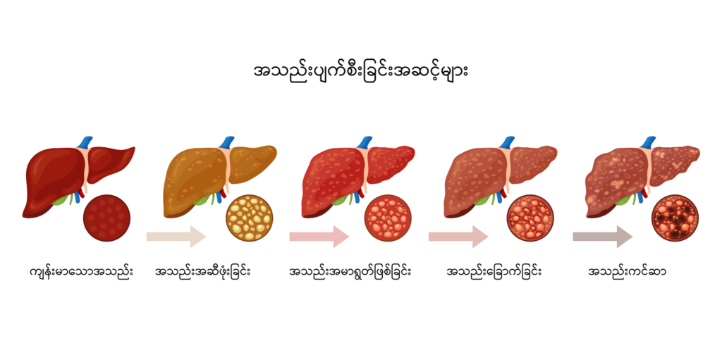 Fatty liver disease image 3