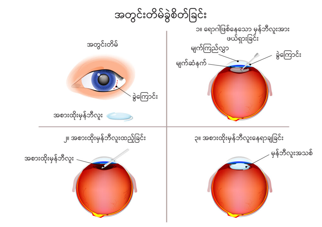 Cataract surgery image 1