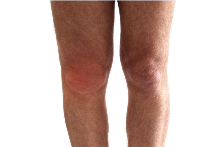 Joint swelling image