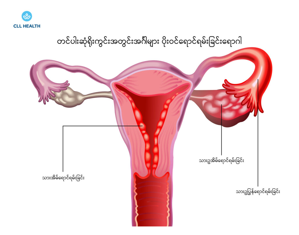 Pelvic inflammatory disease image 1