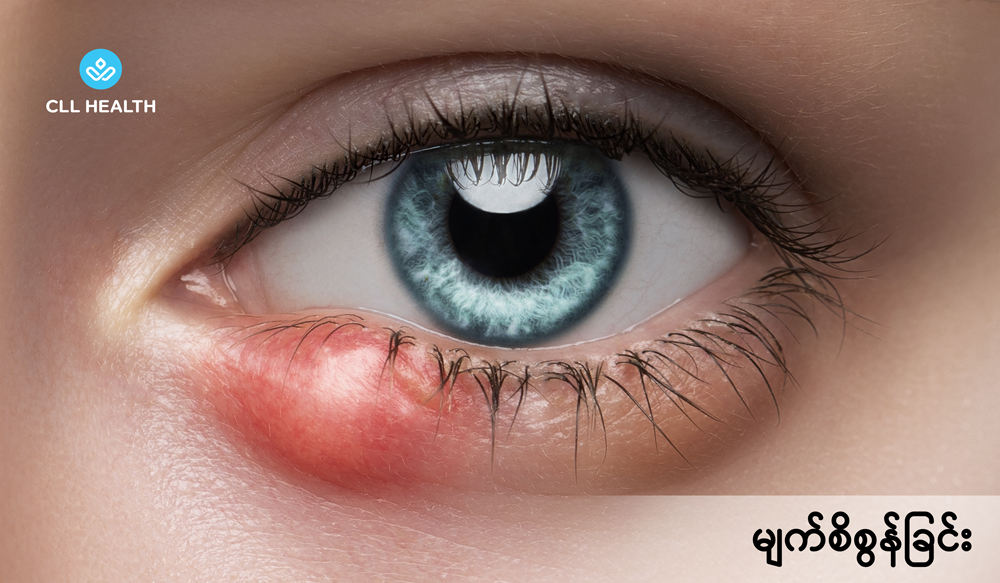 Stye or hordeolum image 1