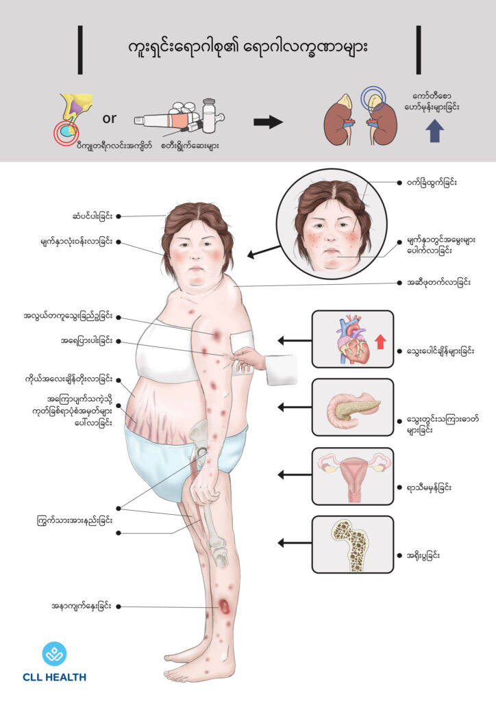 Cushing syndrome image2