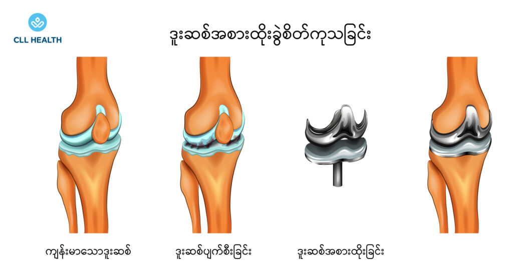 Joint replacement surgery image