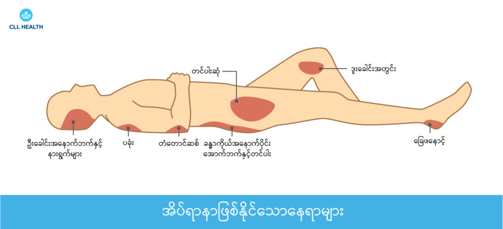 Bed sores image