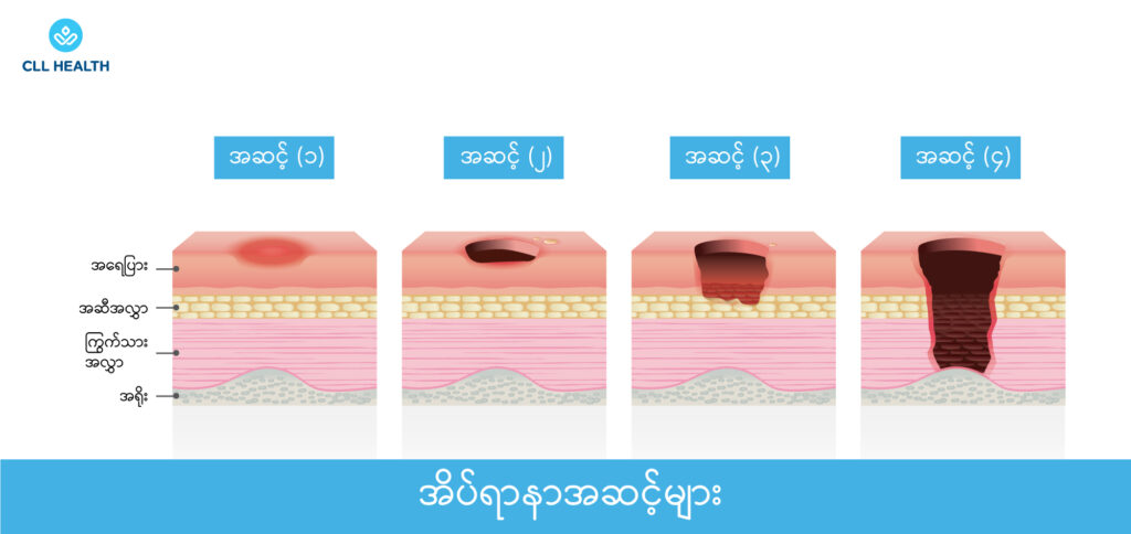 Bed sores image2