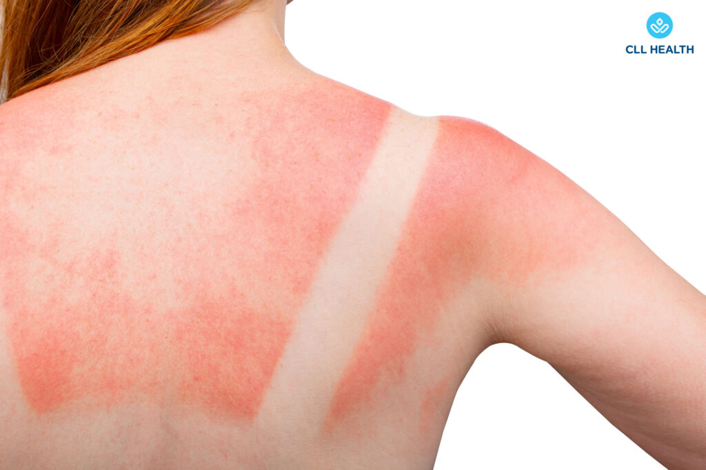 Sunburn image1