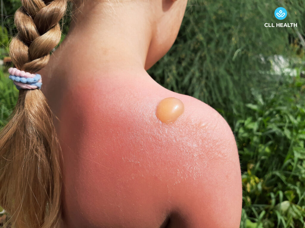 Sunburn image2