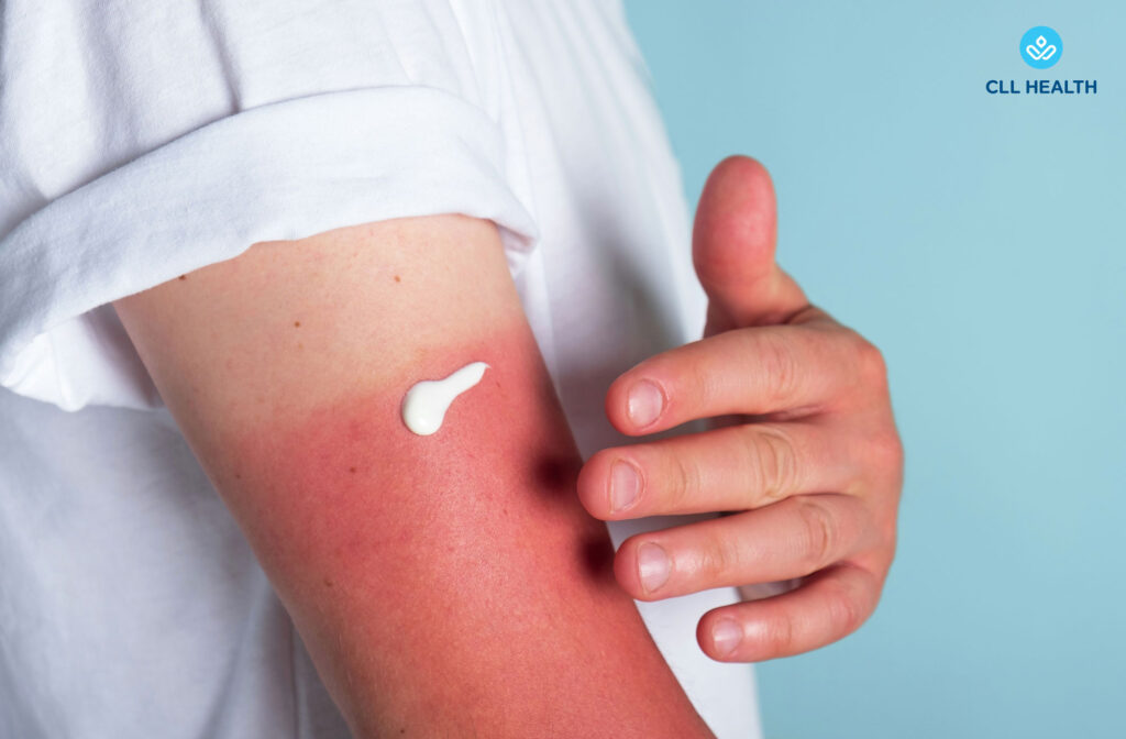 Sunburn image3