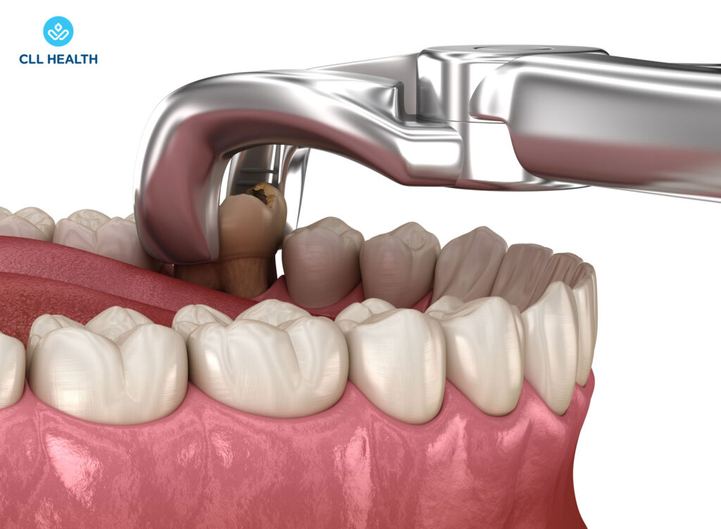 Tooth extraction image