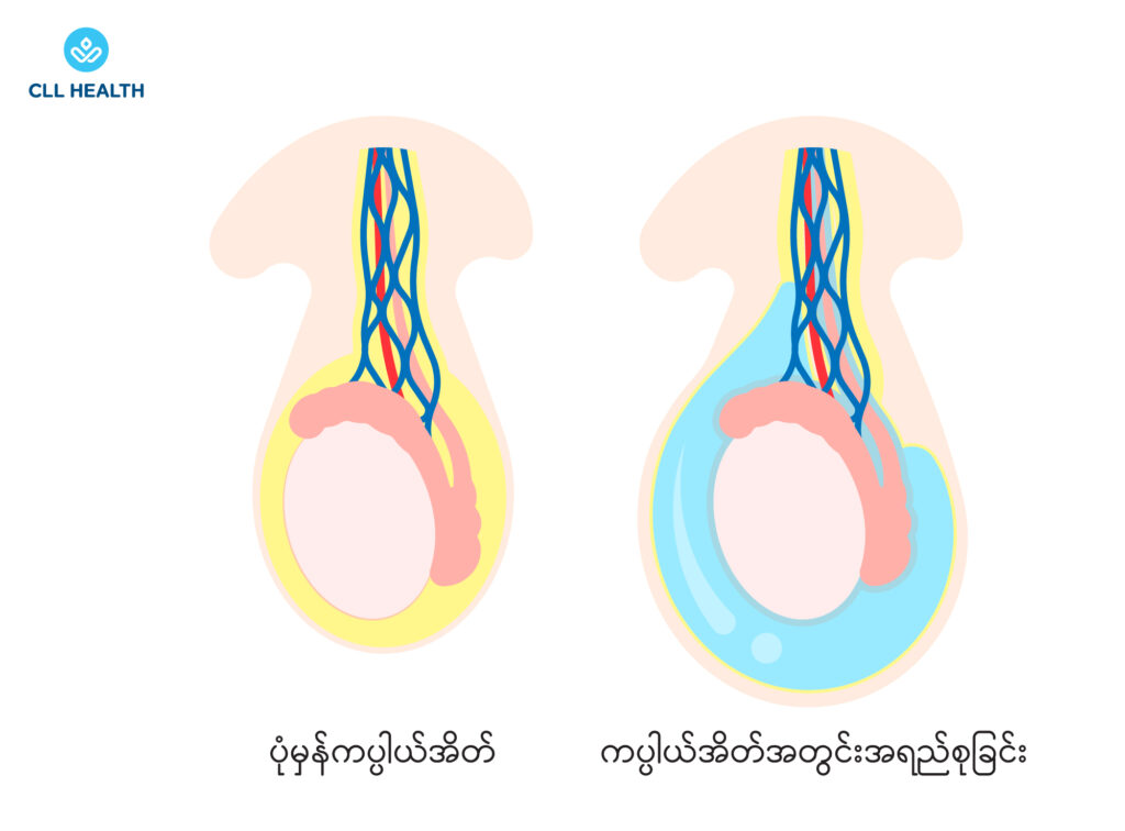 hydrocele image 1