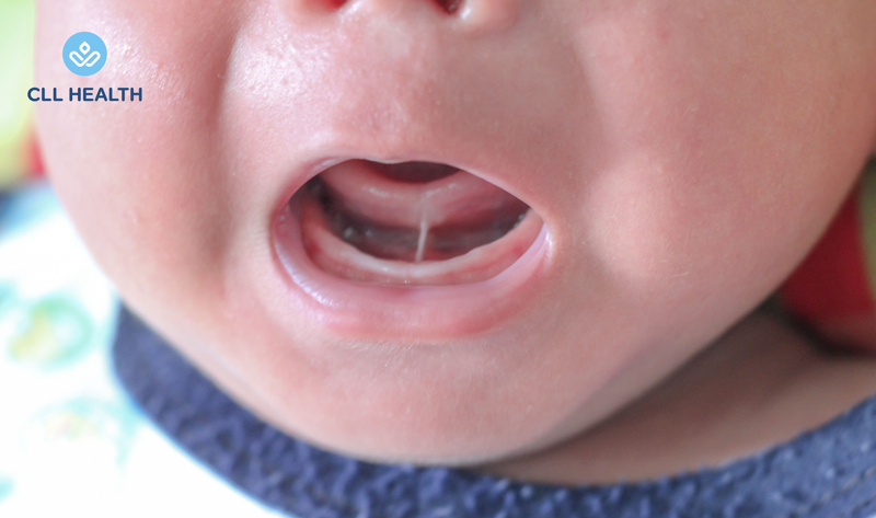 Tongue tie image