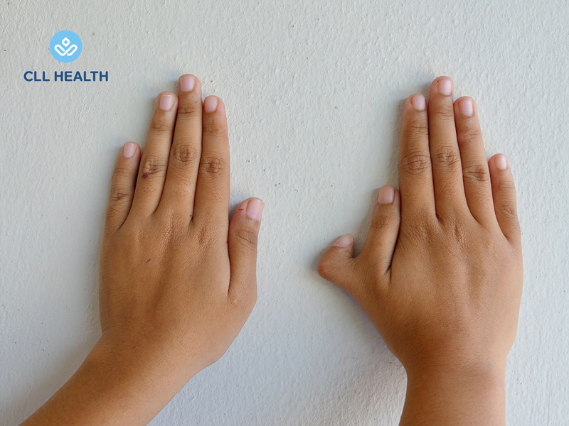 Congenital limb anomalies image