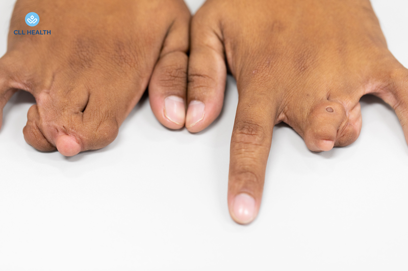 Congenital limb anomalies image2