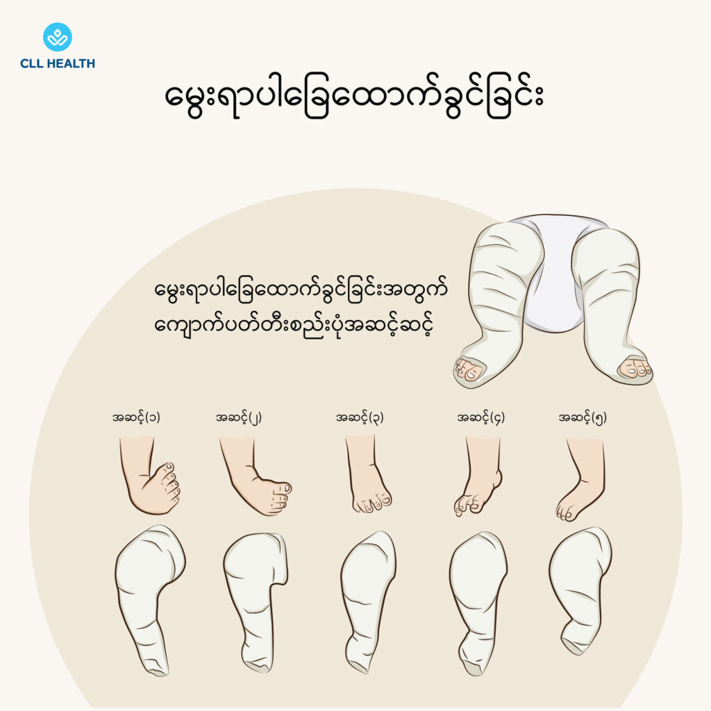 Club foot image 1