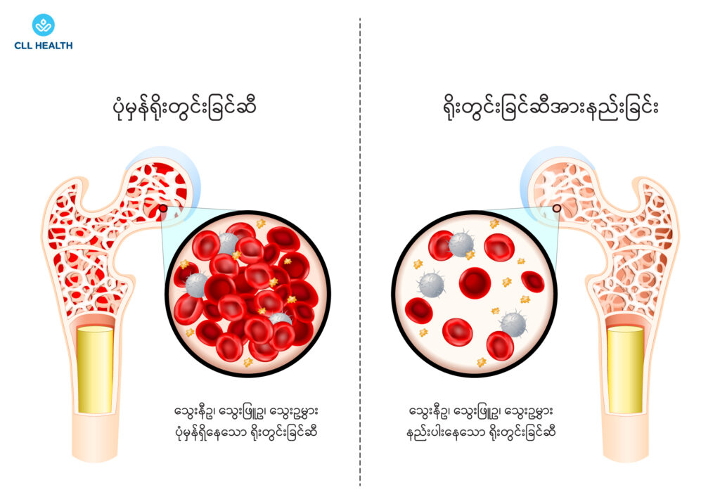 Aplastic anaemia image 1