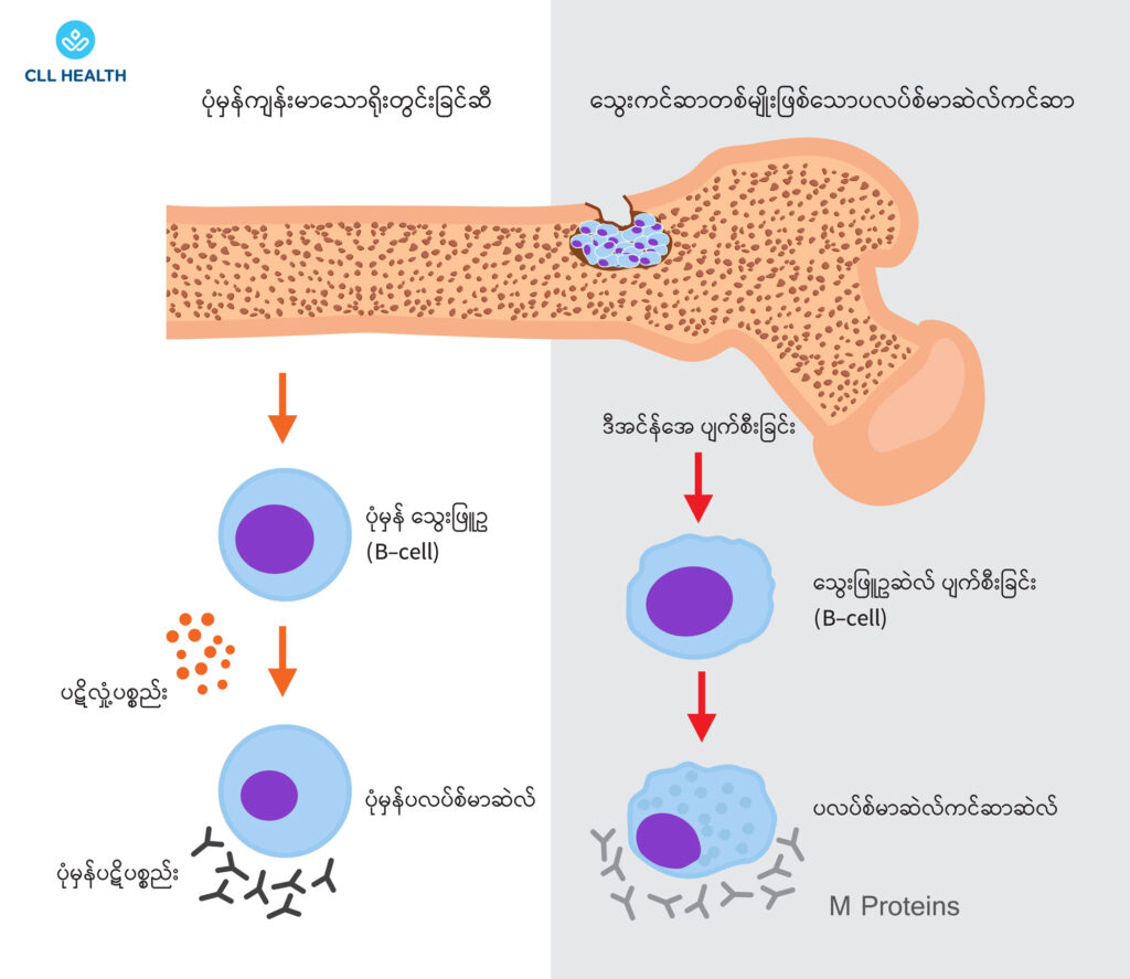 multiple myeloma image 1