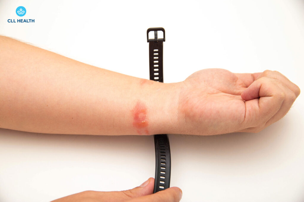Contact dermatitis image 1
