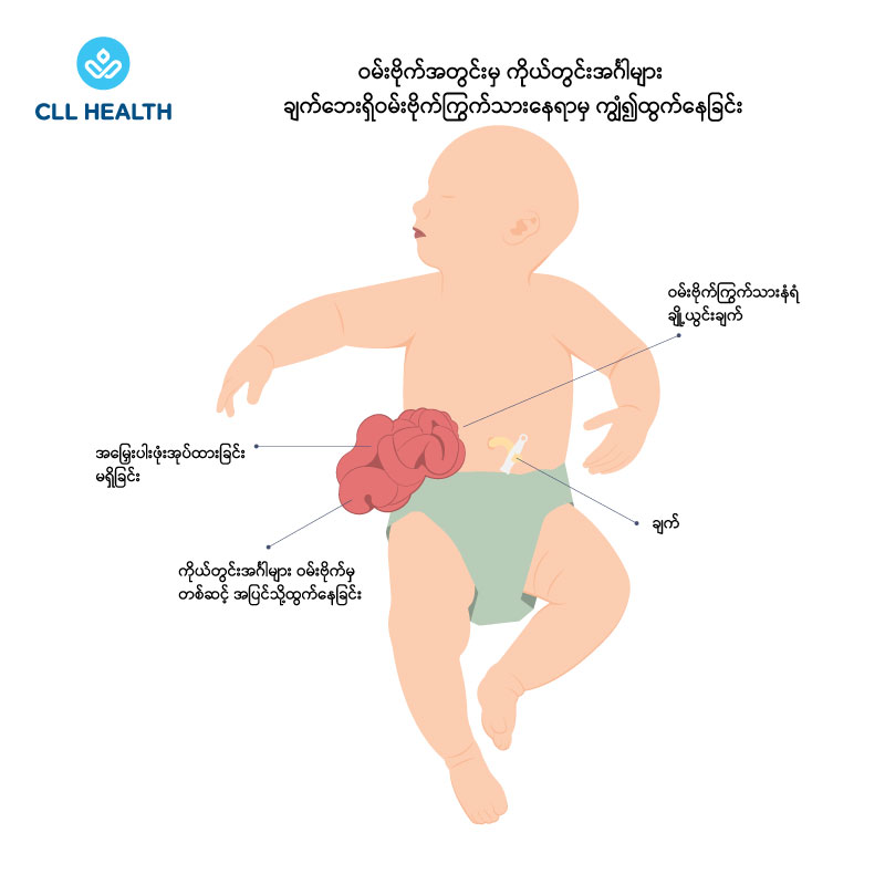 Gastroschisis and Omphalocele image2