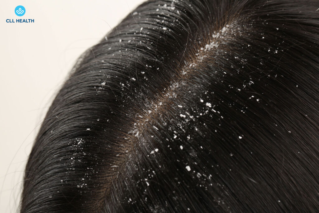 Dandruff image