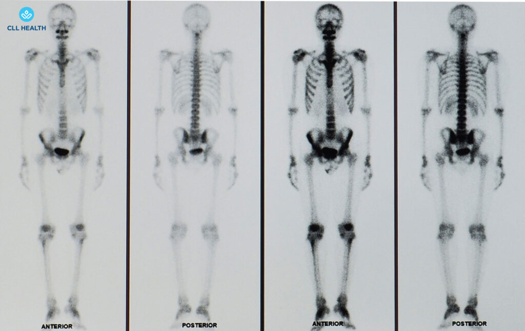Bone scan image 1