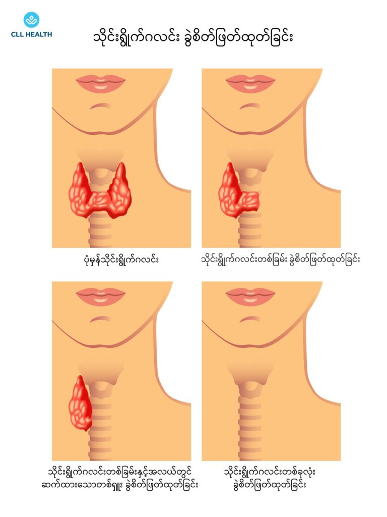 Thyroidectomy image 1