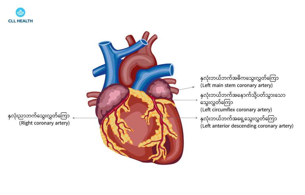 CABG Image 1