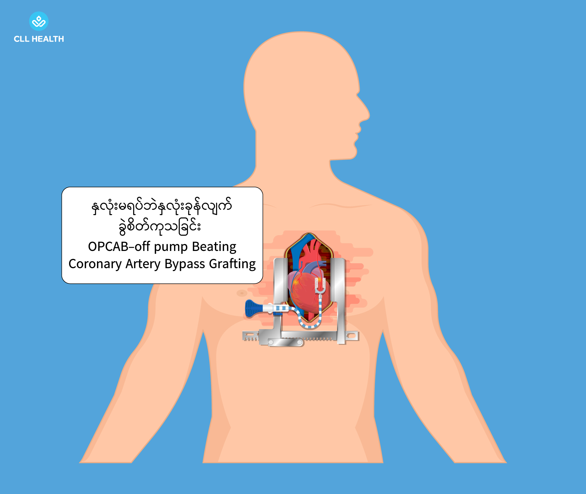 CABG Image 2