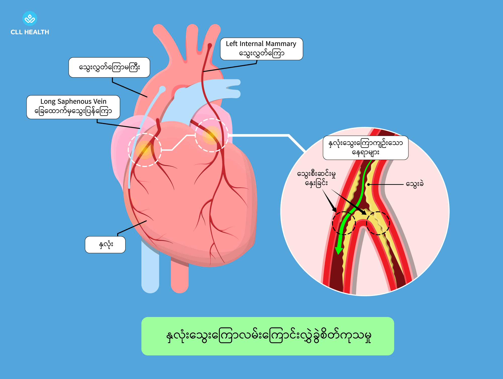 CABG Image 3