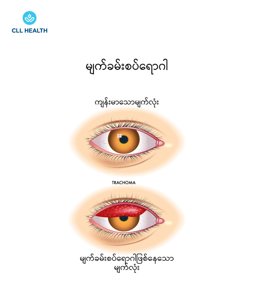 trachoma image 1