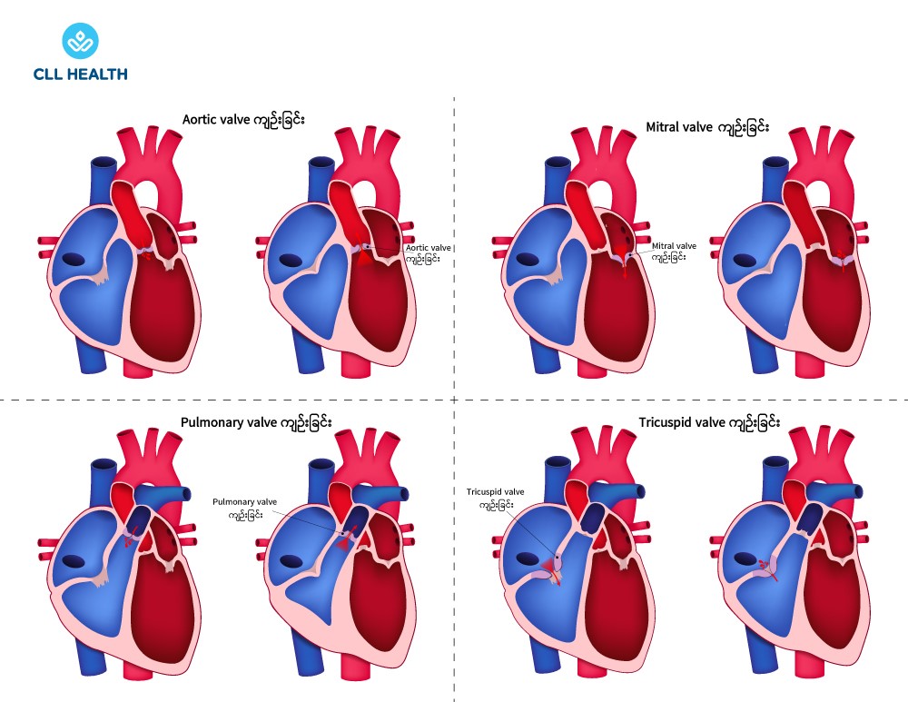 Valvular heart disease image 1