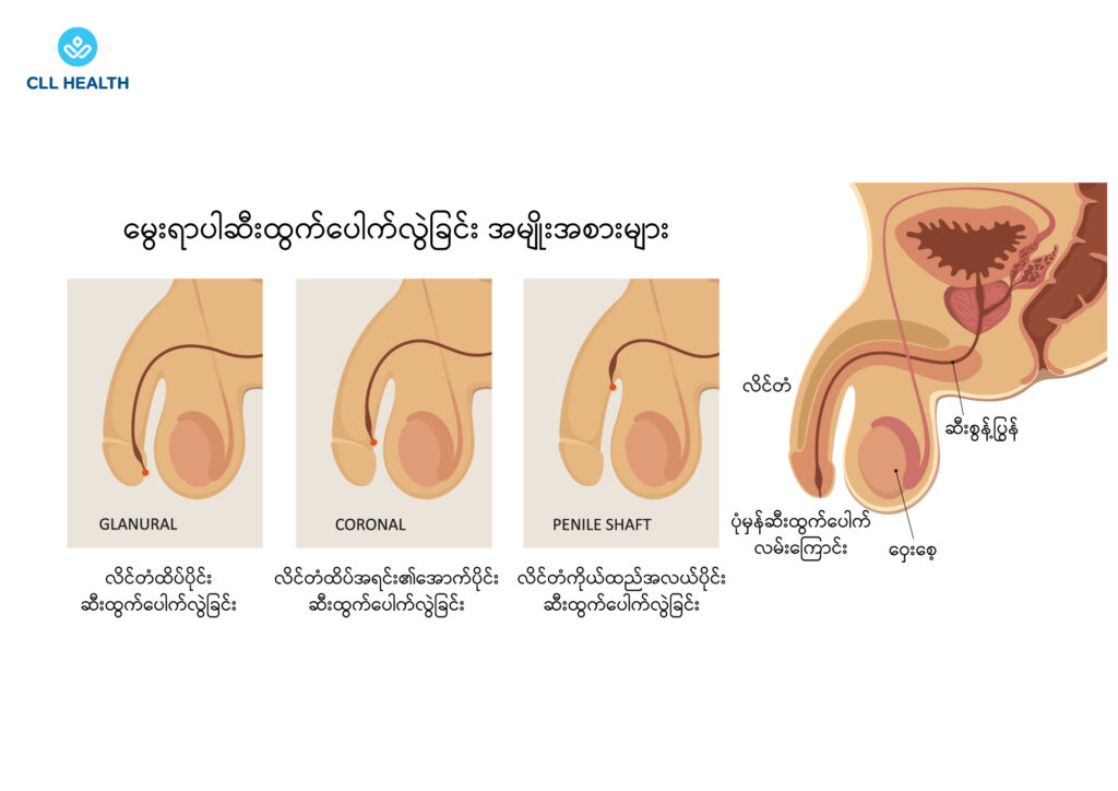 hypospadias image 1