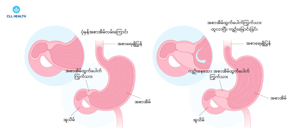 Hypertrophic pyloric stenosis image 1