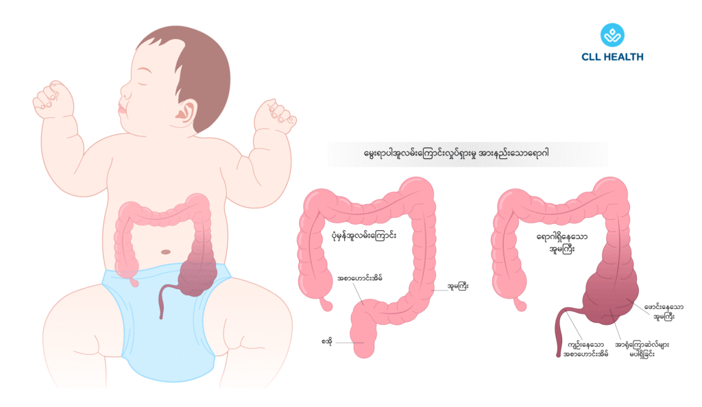Hirschsprung's disease image 1