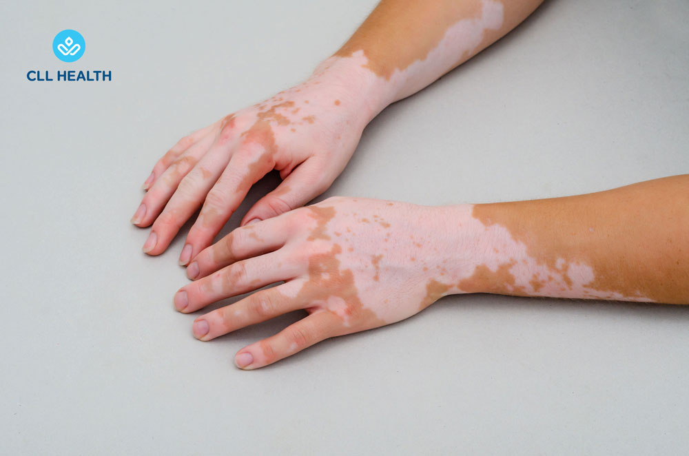 Vitiligo Image 1