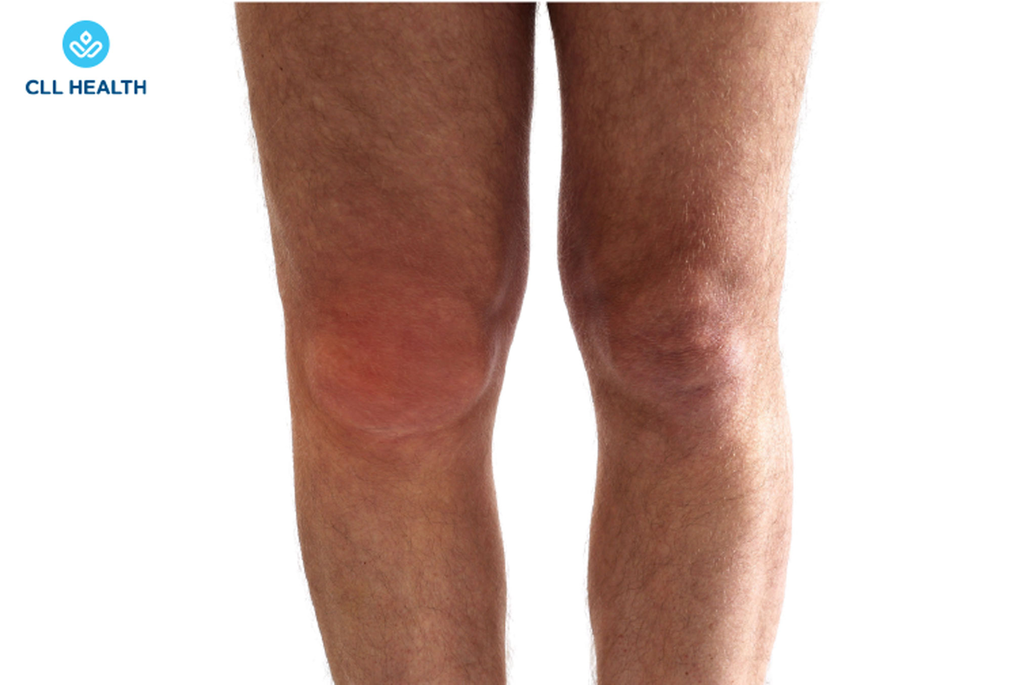 Joint swellings image and also used in Juvenile Idiopathic arthritis