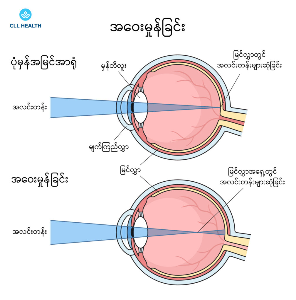 refractive errors image 1