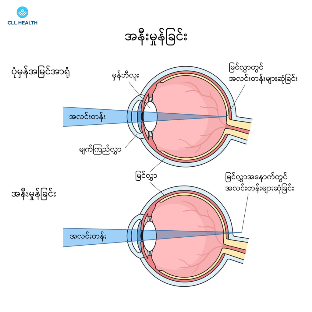 refractive errors image 2